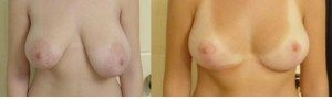 Ανισομαστία με υπερτροφία του αριστερού μαστού και φυσιολογικό μέγεθος του δεξιού. Μετεγχειρητικό αποτέλεσμα μετά από μειωτική στον υπερτροφικό μαστό και μαστοπηξία (για ανόρθωση) του άλλου.