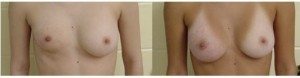 Ανισομαστία με υποπλασία του δεξιού μαστού και φυσιολογικό μέγεθος του αριστερού. Μετεγχειρητικό αποτέλεσμα μετά από αυξητική του υποπλαστικού μαστού.